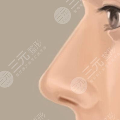 小翹鼻子整形手術(shù)術(shù)前