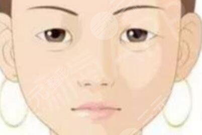 雙眼皮多項(xiàng)整形恢復(fù)過程圖