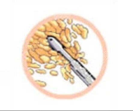 火鳳凰面部溶脂日記:跟煩人肉肉臉說(shuō)byebye~