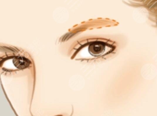 激光洗眉過(guò)程詳情