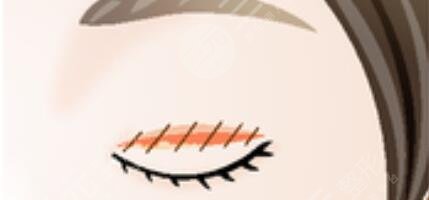 割雙眼皮恢復(fù)過程圖:恢復(fù)過程