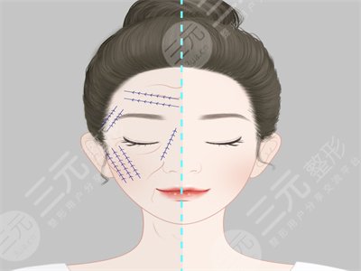 面部拉皮整容手術后一周