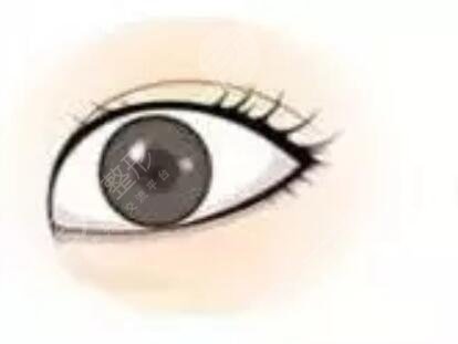 全切雙眼皮1個(gè)月恢復(fù)圖片