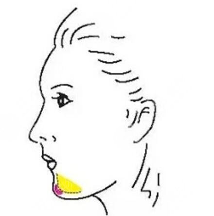 假體墊下巴術(shù)后2天