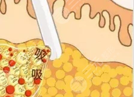 福州吸脂醫(yī)院手術(shù)案例