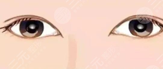 李天石雙眼皮修復(fù)要多少錢？修復(fù)成功案例品鑒~