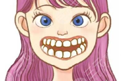 上海圣貝口腔正畸案例