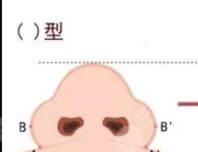 藝興整形醫(yī)院隆鼻整形案例