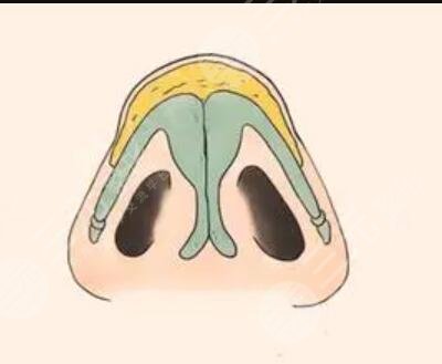 醫(yī)院隆鼻整形案例