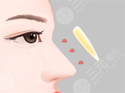 洛陽(yáng)二院整形美容科隆鼻整形案例