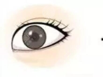 蘇大附一院整形美容科怎么樣，雙眼皮案例