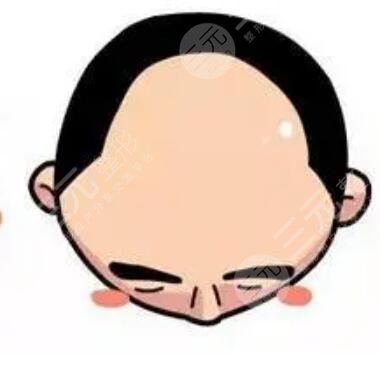 北京301植發(fā)果怎樣