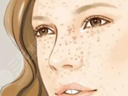 北京聚美匯成激光祛斑后3個月