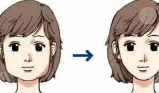 磨骨手術(shù)的過(guò)程