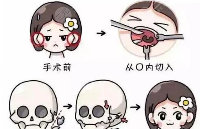 磨骨手術(shù)之后護(hù)理