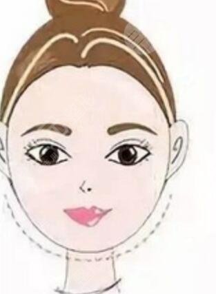 李志海下頜角切除案例欣賞