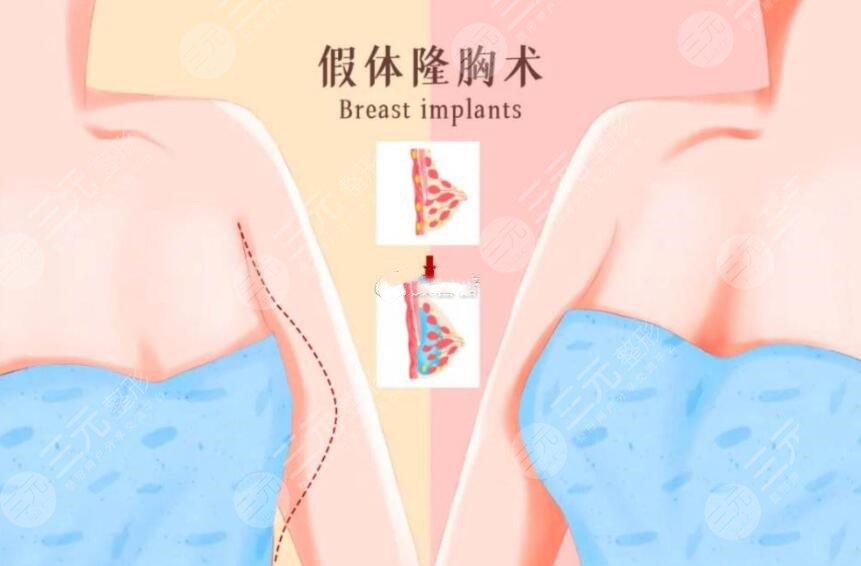 隆胸案例術(shù)前