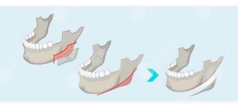 李志海下頜角切除案例欣賞