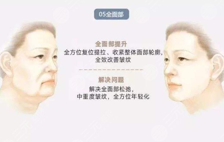 穆寶安v美減齡能保持多久?10年?術(shù)前準(zhǔn)備+術(shù)后護(hù)理盤點!