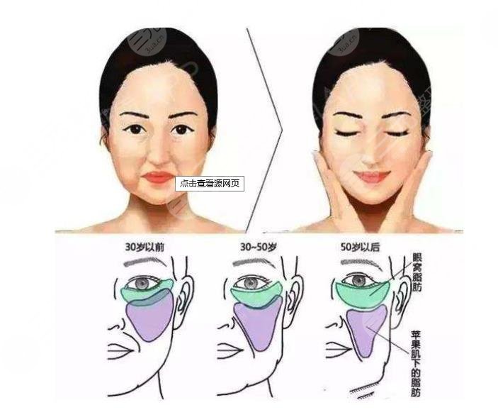 穆寶安v美減齡能保持多久?10年?術(shù)前準(zhǔn)備+術(shù)后護(hù)理盤點!