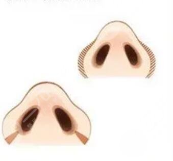 深圳雅星醫(yī)療美容醫(yī)院綜合鼻案例