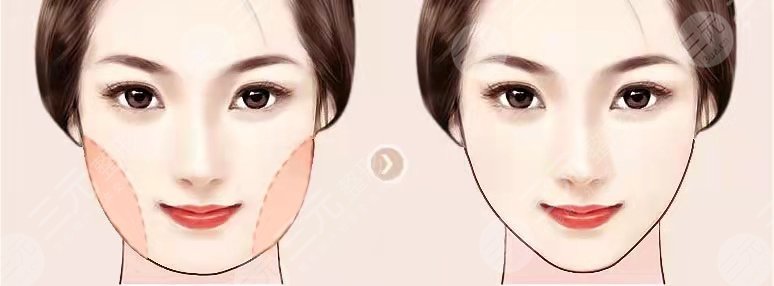 武漢同濟(jì)馮幼平面部吸脂前