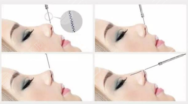 昆山達拉斯劉波隆鼻術(shù)后3天