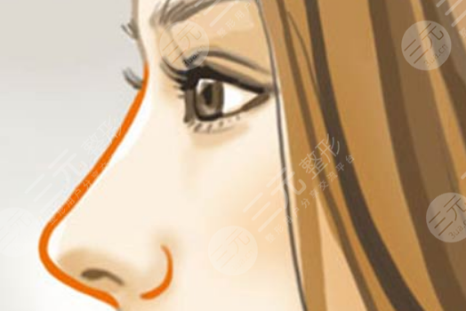 昆山達拉斯劉波肋軟骨鼻部手術(shù)案例