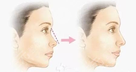 汪志強(qiáng)做鼻子怎么樣