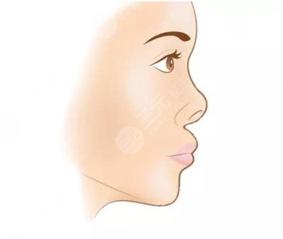 汪志強(qiáng)醫(yī)生整形鼻子案例介紹