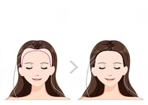 北京中德植發(fā)醫(yī)院發(fā)際線改良植發(fā)經(jīng)歷分享