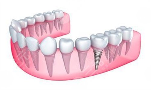北京德貝口腔種植牙案例分享
