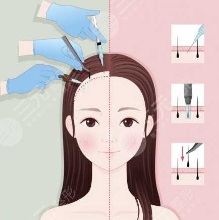 太原大麥微針植發(fā)醫(yī)院發(fā)際線改良種植案例