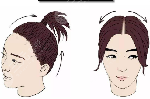 沈陽華美植發(fā)醫(yī)院發(fā)際線種植案例