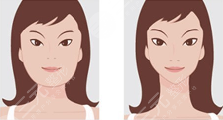 李志海磨骨成好嗎