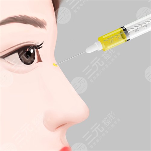 上海九院戴婷婷醫(yī)生鼻部手術(shù)整形案例分享