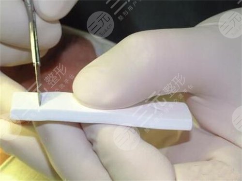 上海九院戴婷婷醫(yī)生鼻部手術(shù)整形案例分享