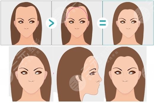 杭州時光種植發(fā)際線的案例果分享
