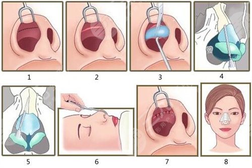 金孝憲鼻修復后一個月