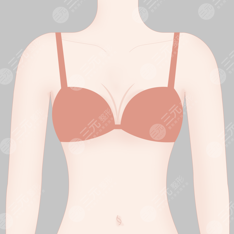 寧波市第六醫(yī)院整形科吸脂案例術后半年