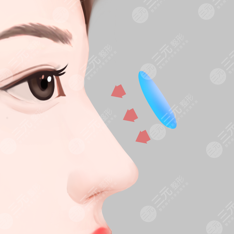 西安西京醫(yī)院隆鼻整形案例