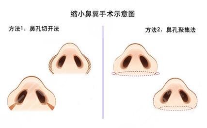 付榮峰做做鼻子案例術(shù)前