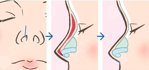 付榮峰做做鼻子案例術(shù)后3周