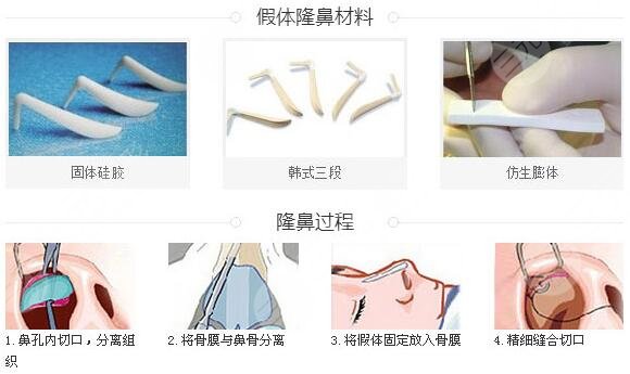 羅匯東做鼻子案例果術(shù)后30天