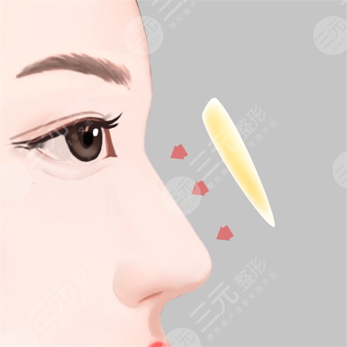 成都西區(qū)鼻部整形價(jià)格表|附隆鼻整形案例反饋