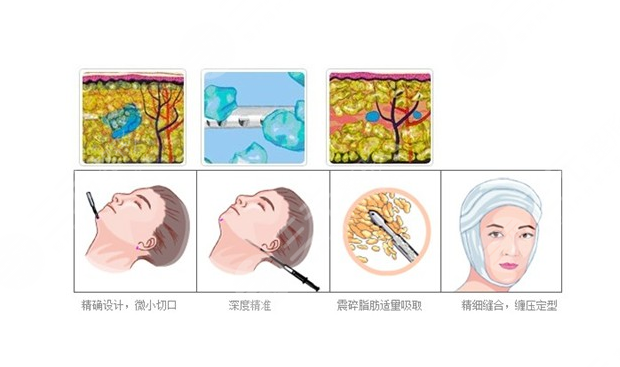  北京佰華利醫(yī)美面部吸脂案例