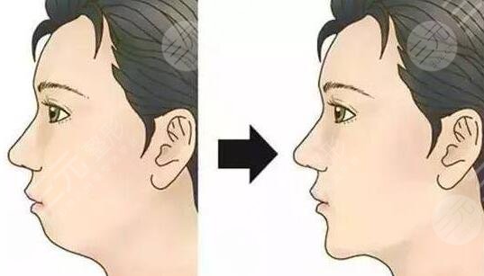 西京整形醫(yī)院假體墊下巴真實(shí)案例分享