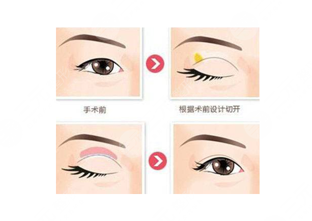 蘭大二院整形科價(jià)格表2021新版，醫(yī)生簡介|雙眼皮修復(fù)案例