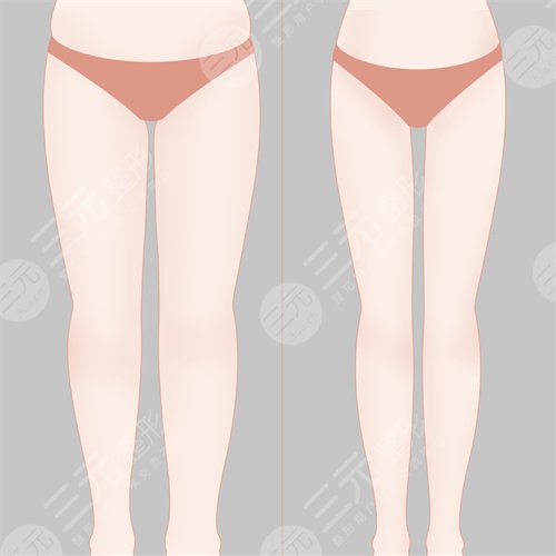 吸脂減肥整形手術之后