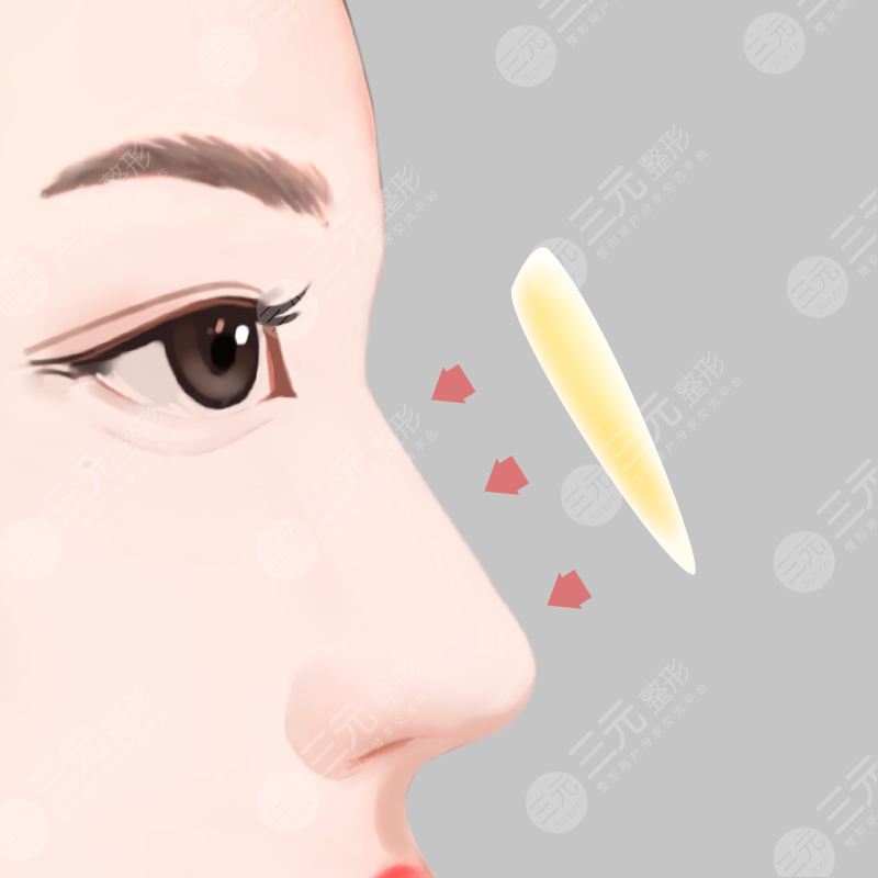 汪志強(qiáng)做鼻子怎么樣